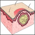 Acne Cyst