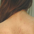 Back Acne Causes – What’s The Deal With Bacne Anyway?