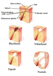 Types & Classifications of Acne