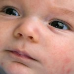 Baby Acne Overview