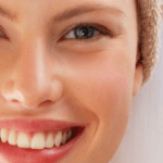 Adult Acne Female
