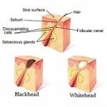 Types / Classifications of Acne - wide view