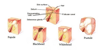 Acne: A Basic Understanding