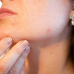 Acne Side Chin Profile