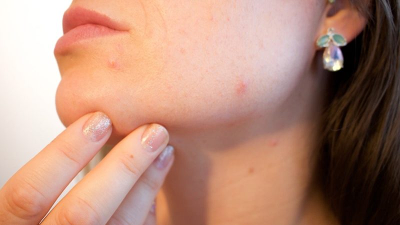 Ways To Clear Up Facial Acne