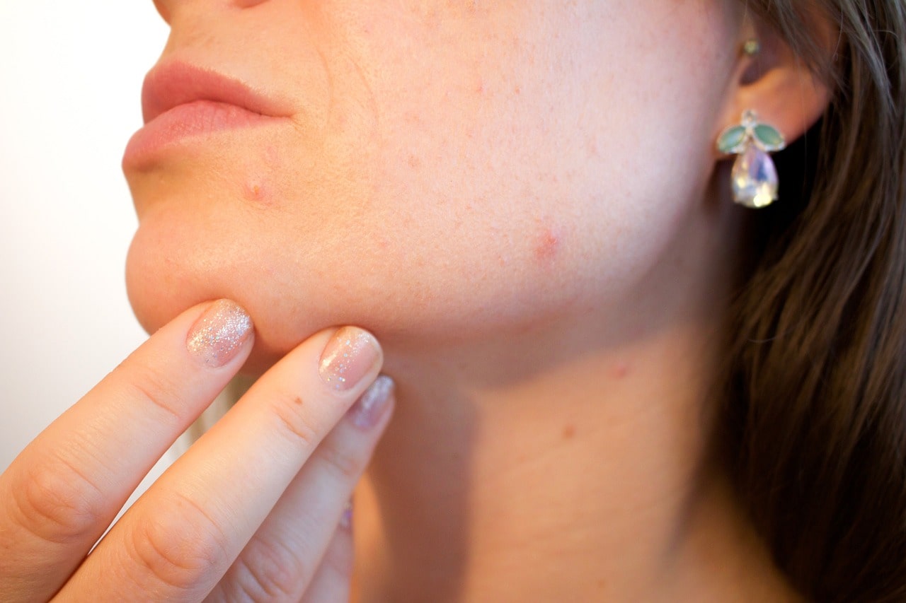 Ways To Clear Up Facial Acne