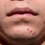 Seeing Results From Acne Treatments