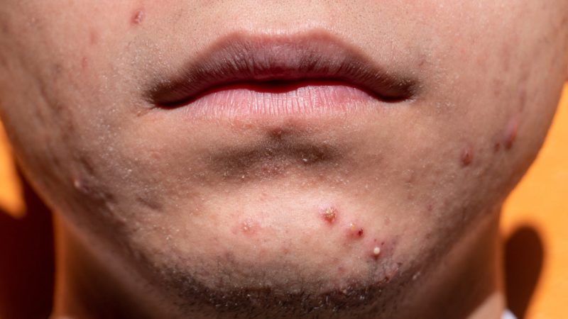 How Long Does It Typically Take To See Results From Acne Treatments