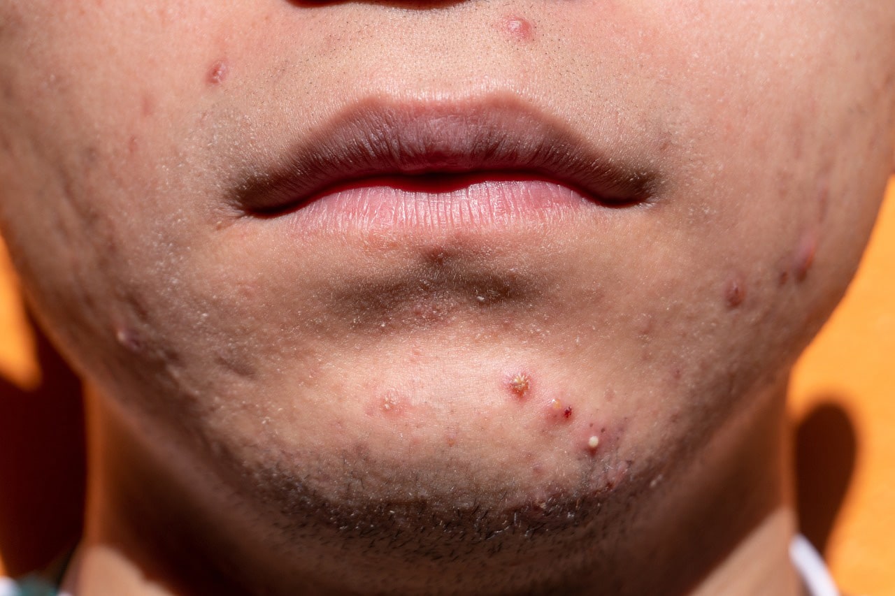 How Long Does It Typically Take To See Results From Acne Treatments