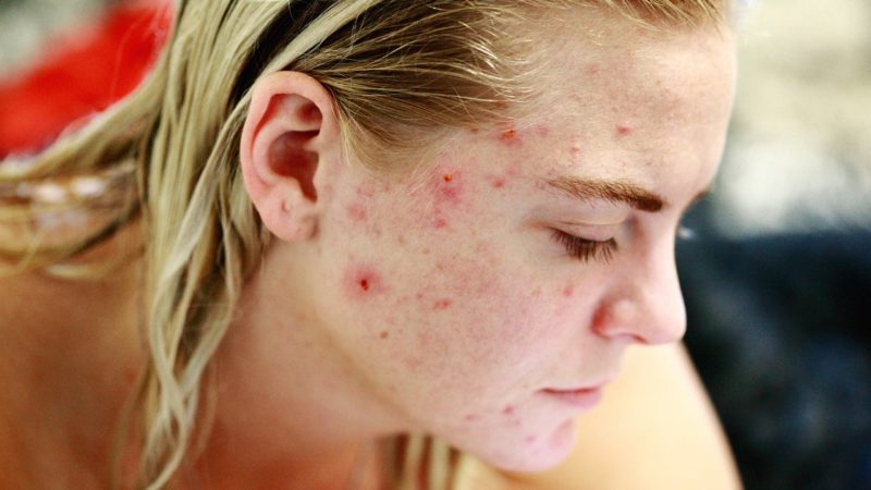 What Are The Best Methods For Preventing Acne Scarring?