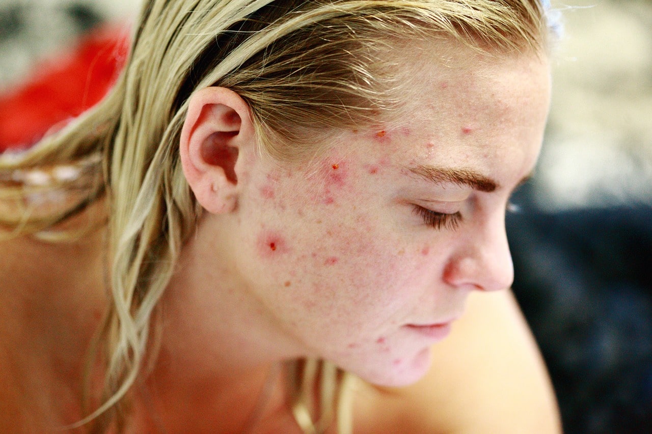 What Are The Best Methods For Preventing Acne Scarring?