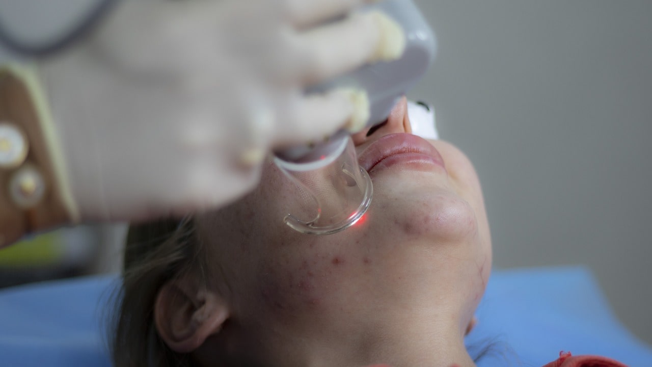 Is It Necessary To Consult A Dermatologist For Mild To Moderate Acne, Or Can Over-The-Counter Products Suffice